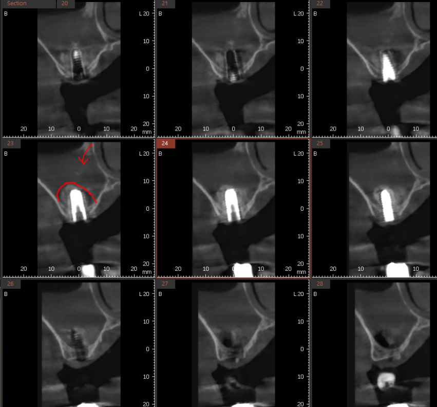 미사 임플란트 상악동 거상술 제일 어렵고 난이도가 높습니다. 관련 이미지 5