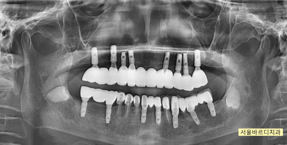상일동 치과 부분 틀니에서 임플란트 바꿔서 사용하기 관련 이미지 11