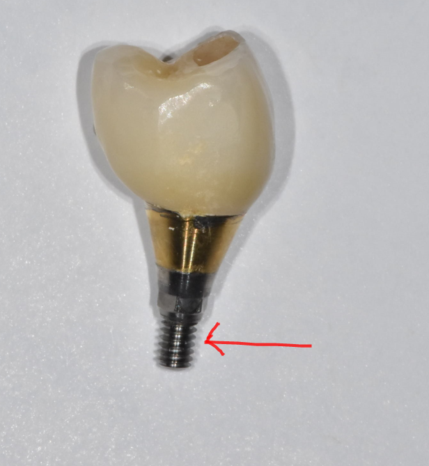 강동구 치과 임플란트 흔들림 나사 풀림 머리가 돌아가요!!! 대처법은? 관련 이미지 3