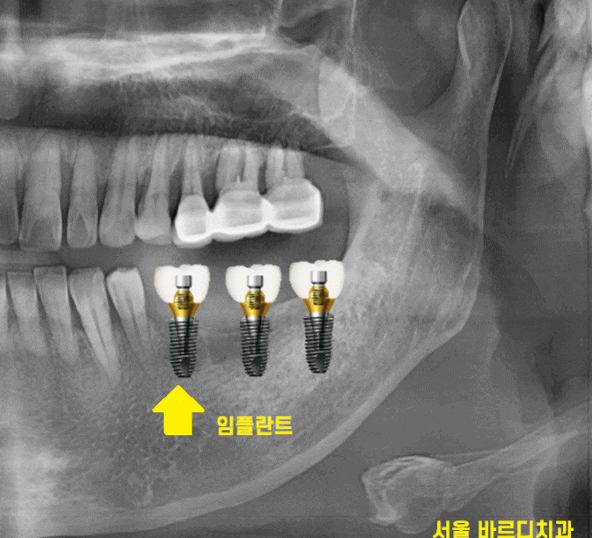 상일동역 치과에서 알려드리는 임플란트 수술과정 대공개 관련 이미지 1