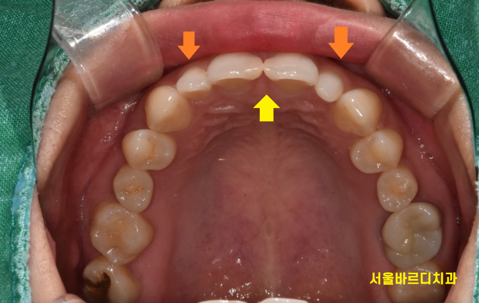 왜소치 라미네이트 작은 치아 콤플렉스 말끔하게 극복해요!! 관련 이미지 4