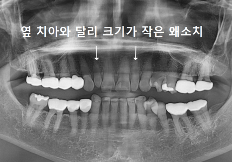 중장년 라미네이트, 70대도 가능한가요? 왜소치와 벌어진 앞니 해결 사례 관련 이미지 6