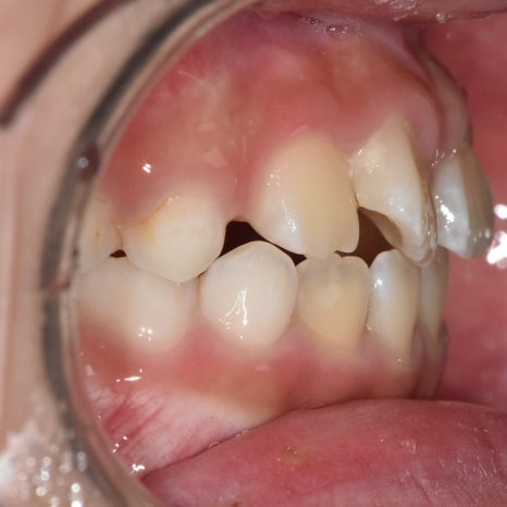 When Should My Child Start Orthodontic Treatment? When to Begin Now vs. When It Is Fine to Wait image 2