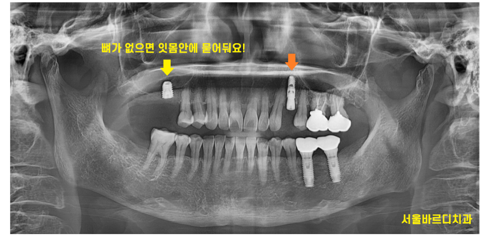 미사역 임플란트 치료 나이 상관이 있을까? 관련 이미지 4