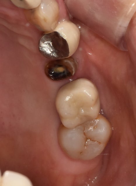 A Case of a 69-Year-Old Who Underwent Immediate Implant Placement After Extraction Due to Tooth Decay in Godeok-dong image 8