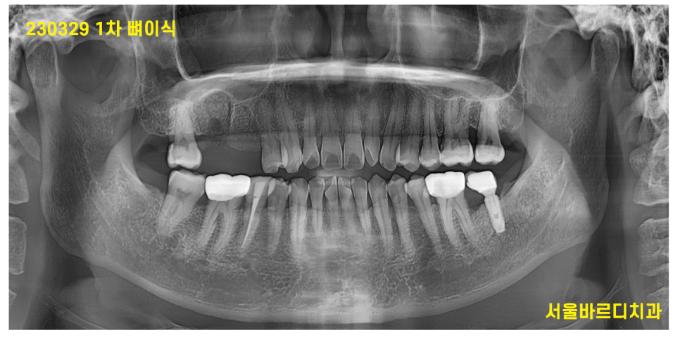 고덕동 치과 잇몸 주저앉음 느낌이 들었다면 늦었을 수도 있습니다. 관련 이미지 6
