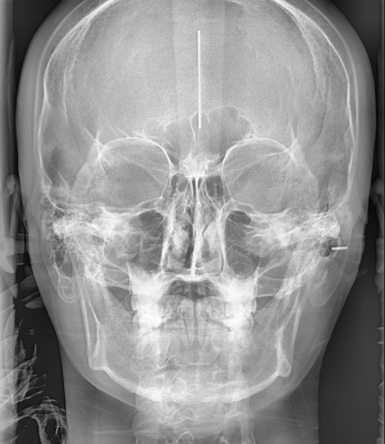 강일동 치아교정 과정 시작부터 마무리까지 알려드려요! 관련 이미지 1