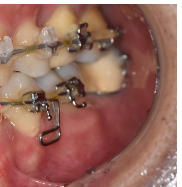 치아에 생긴 하얀 얼룩, 왜 생기나요? 초기 충치일 수 있습니다. 관련 이미지 2
