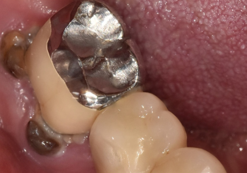 고덕동 어금니 브릿지 교체, 관련 이미지 5