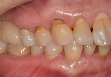 대문니 파절, 앞니에 금이 쩍 갈라졌다면? 딱딱한 음식을 조심해야 하는 이유 관련 이미지 9