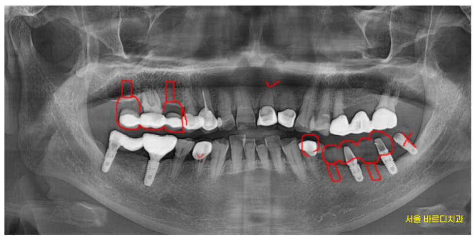 망월동 치과  양쪽 어금니 문제가 있을때 치료 순서는? 관련 이미지 3