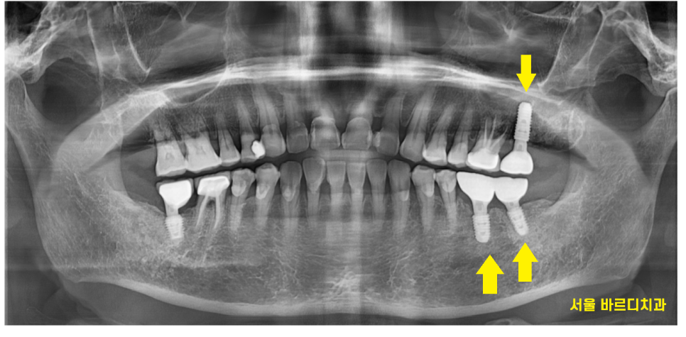 고덕동 치과 어금니 흔들림과 통증 임플란트가 답일 때! 관련 이미지 10