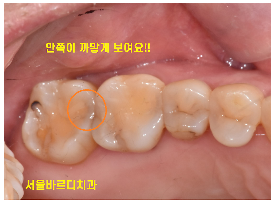 치실 안쓰면 이렇게 됩니다!!  치아 사이 충치 인레이 치료 관련 이미지 4