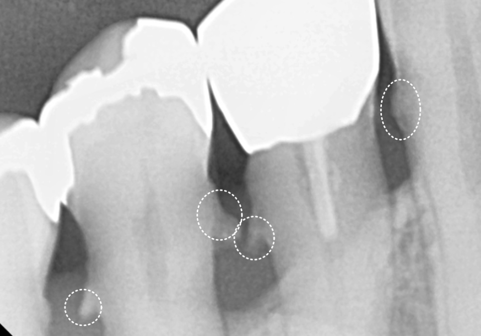 고덕동 스케일링 미루다 앞니 어금니 다 뽑고 임플란트 했습니다. 관련 이미지 5