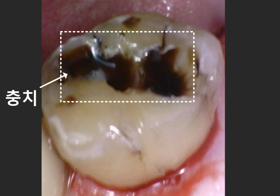 상일역 치과, 오래된 금니 빠짐, 같은 증상으로 내원했지만 전혀 다른 결과, 그 차이는? 관련 이미지 13