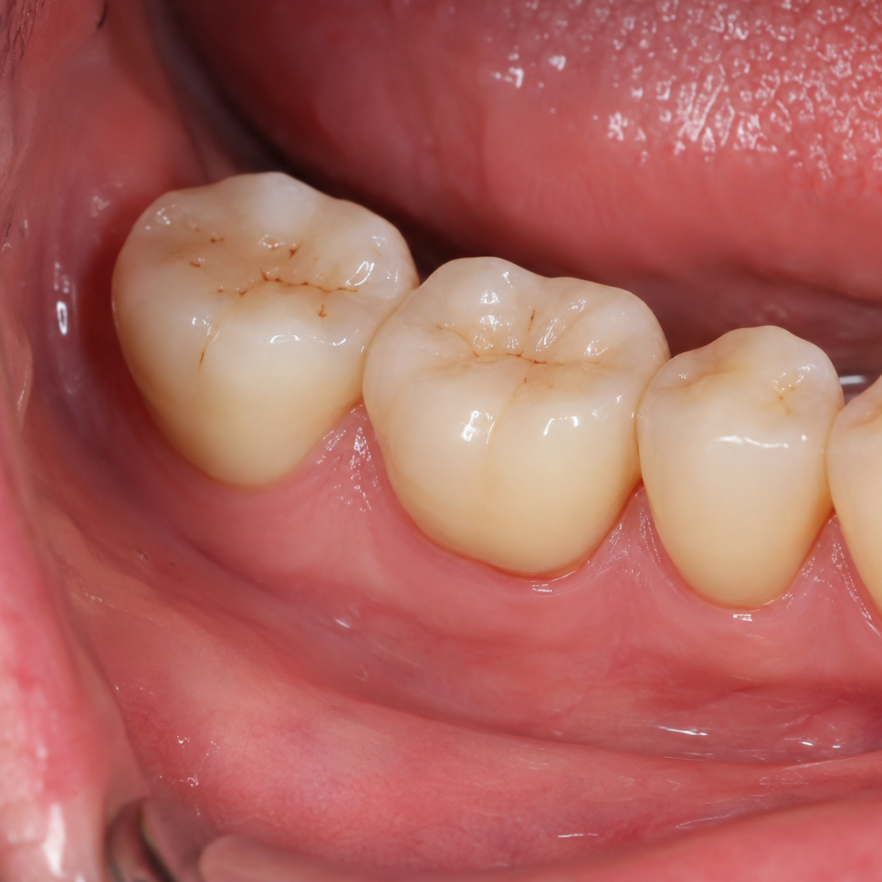 Dental Implants in Just One Day? Is a One-Day Implant Possible for Everyone? image 1