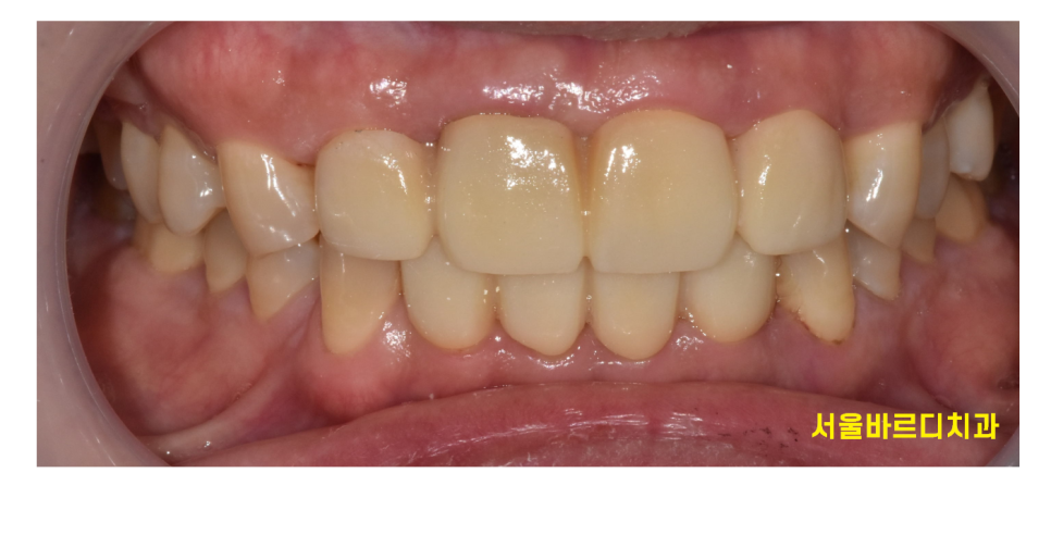 앞니 사이 간격 넓어짐 치아가 벌어져서 보기 싫을 때 크라운 치료 관련 이미지 8