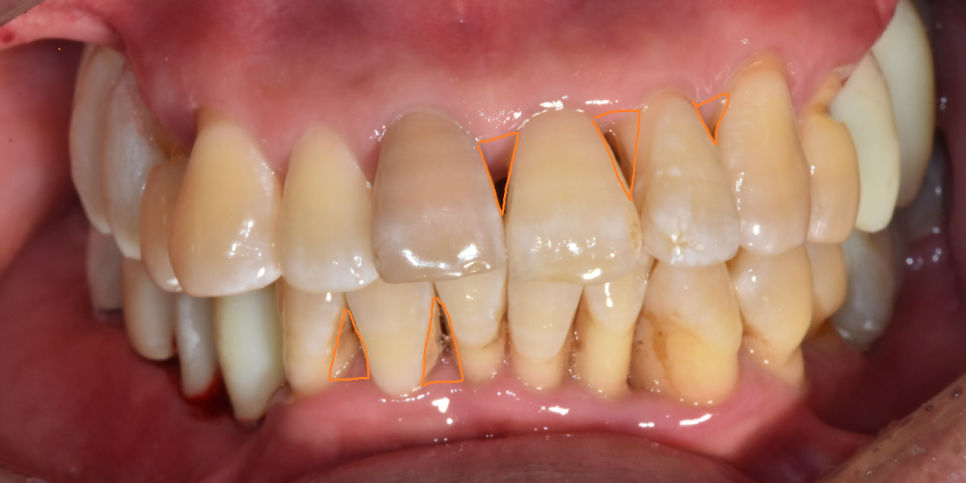 고덕 치과 잇몸 무너짐 천천히 진행되어서 더 무섭다. 관련 이미지 3
