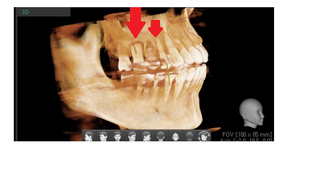 고덕동 치과 잇몸 주저앉음 느낌이 들었다면 늦었을 수도 있습니다. 관련 이미지 5