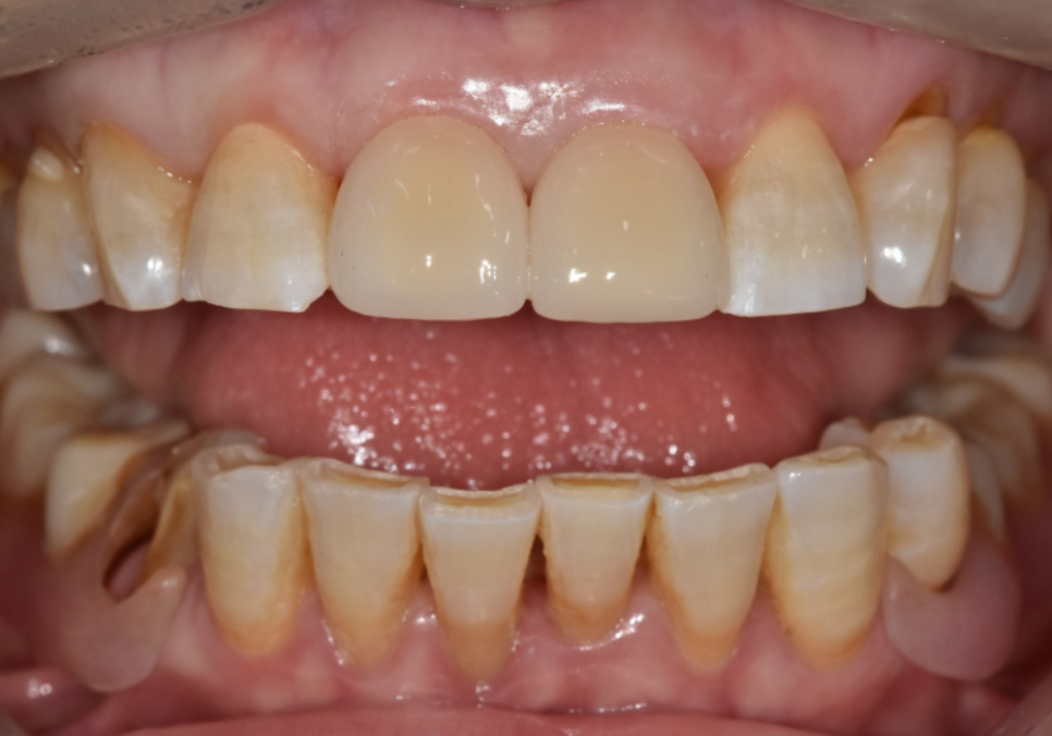 앞니 끝부분 깨짐, 다듬기, 레진, 라미네이트? 어떤 치료가 나에게 적합할까? 관련 이미지 12