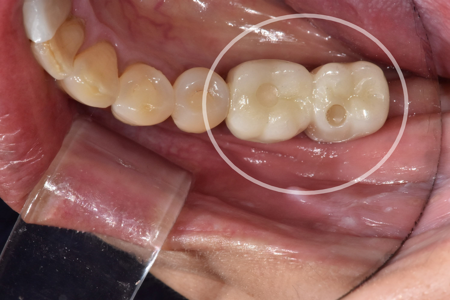 고덕동치과 임플란트 정기검진, 미루다가 수십만 원 손해 봅니다. 관련 이미지 3