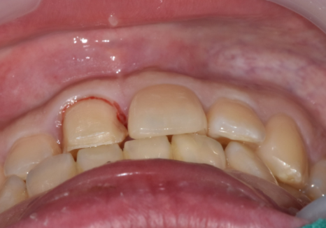 천호 라미네이트 파절 탈락, 줄이려면 치과 선택이 중요합니다. 관련 이미지 14