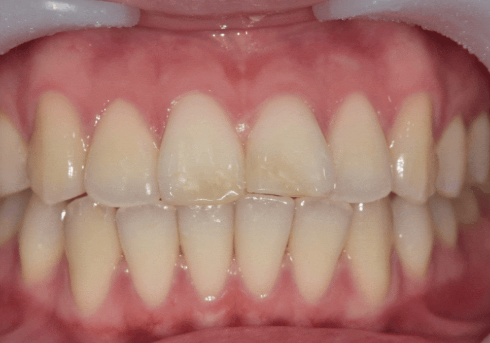 절단교합으로 인한 앞니 레진 깨짐, 교정 없이 해결한 사례 관련 이미지 10