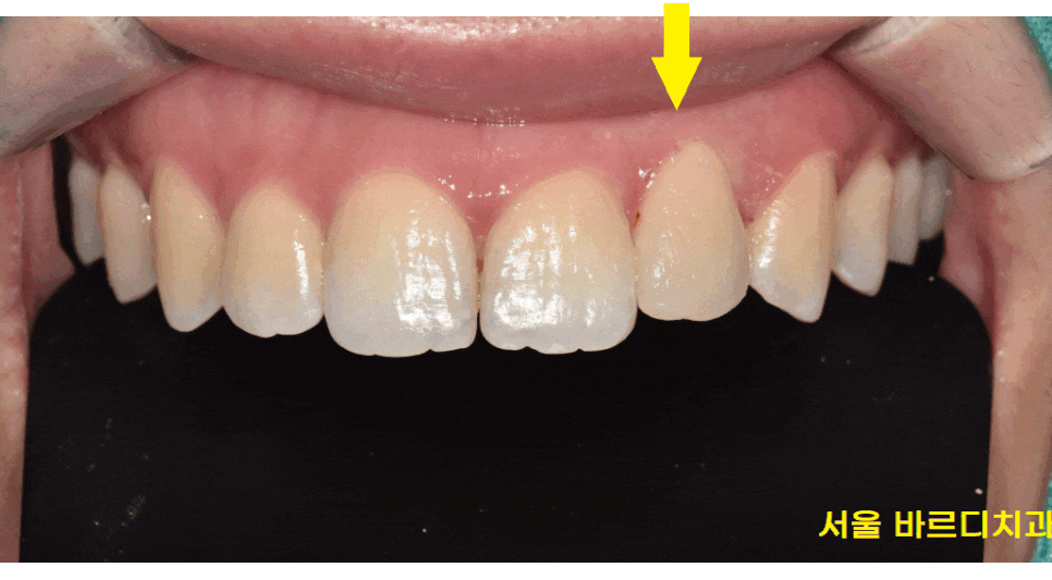 앞니 레진 변색으로 무삭제 라미네이트 진행했습니다. 관련 이미지 1