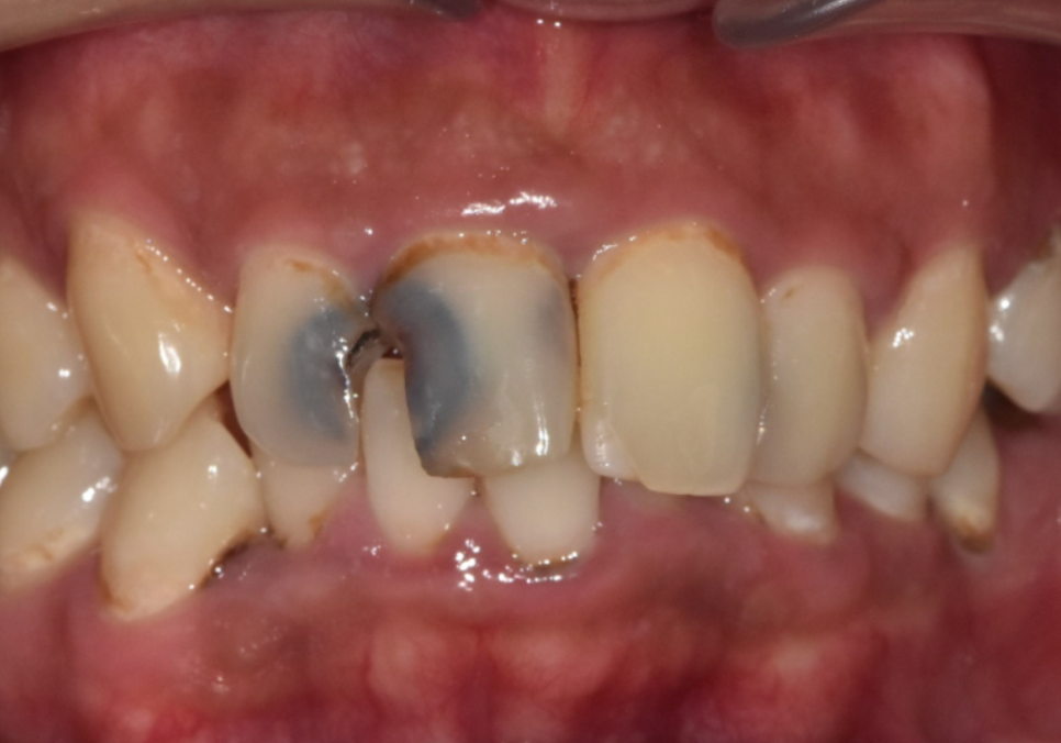 A Single Black Spot of Decay Between the Front Teeth May Be a Warning Sign of Multiple Cavities. image 5