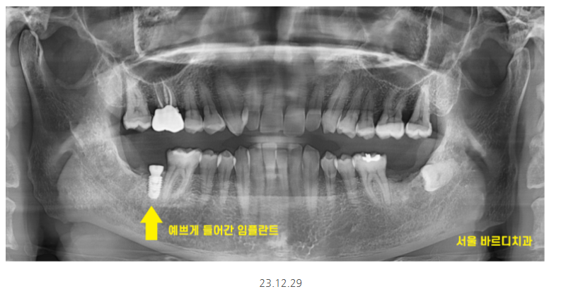 하남시청치과 내비게이션 임플란트 뭐가 좋아요?? 관련 이미지 7
