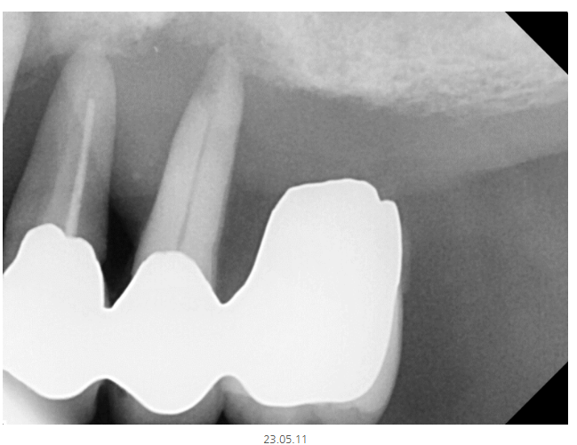 미사 임플란트 70대 연령과 상관없는 치료 과정 관련 이미지 2