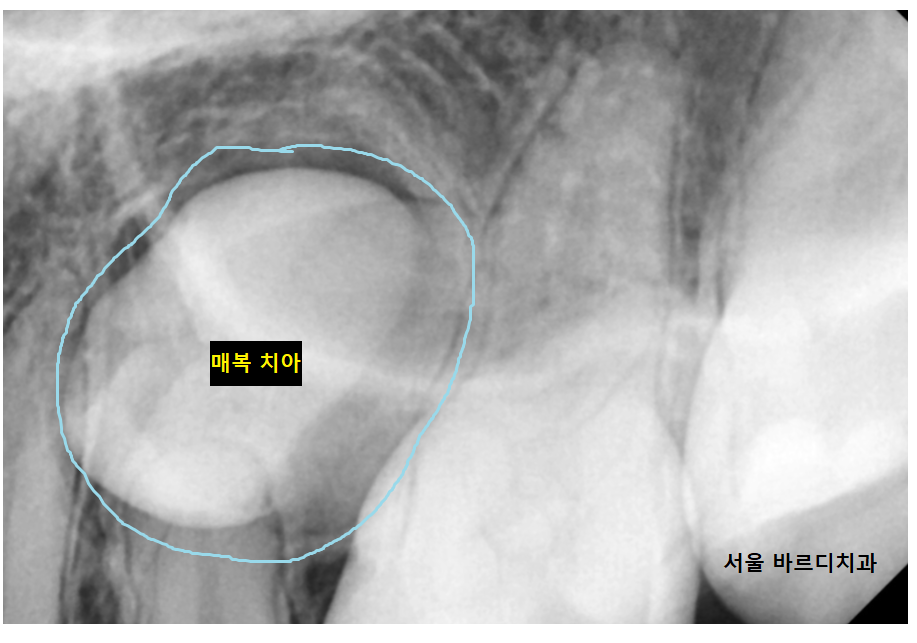 덕풍동 치과 교정 치료 위해 숨어있는 매복치 수술 발치 문제없습니다 관련 이미지 6