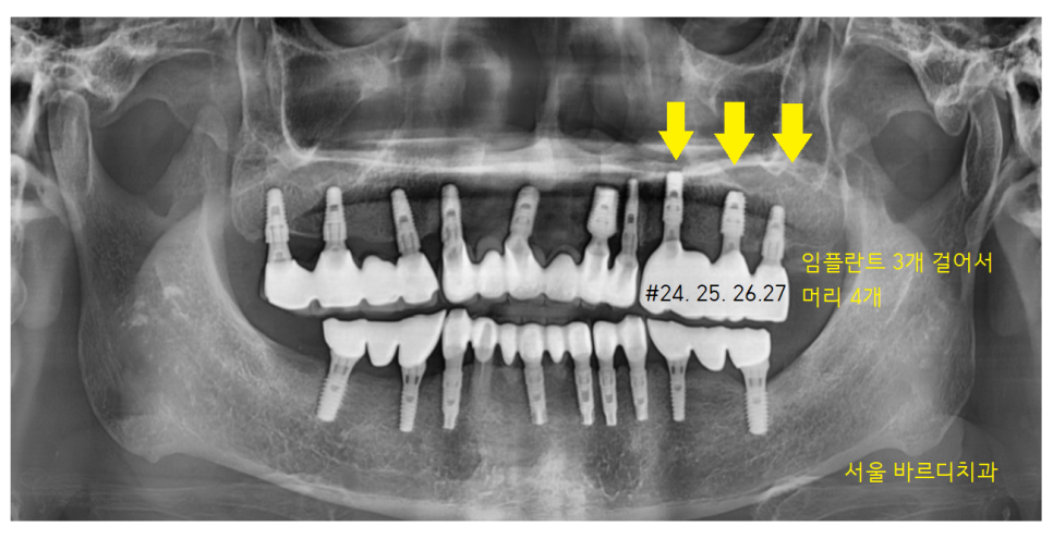 덕풍동 치과 오래된 임플란트 제거 후 재식립하였습니다. 관련 이미지 12