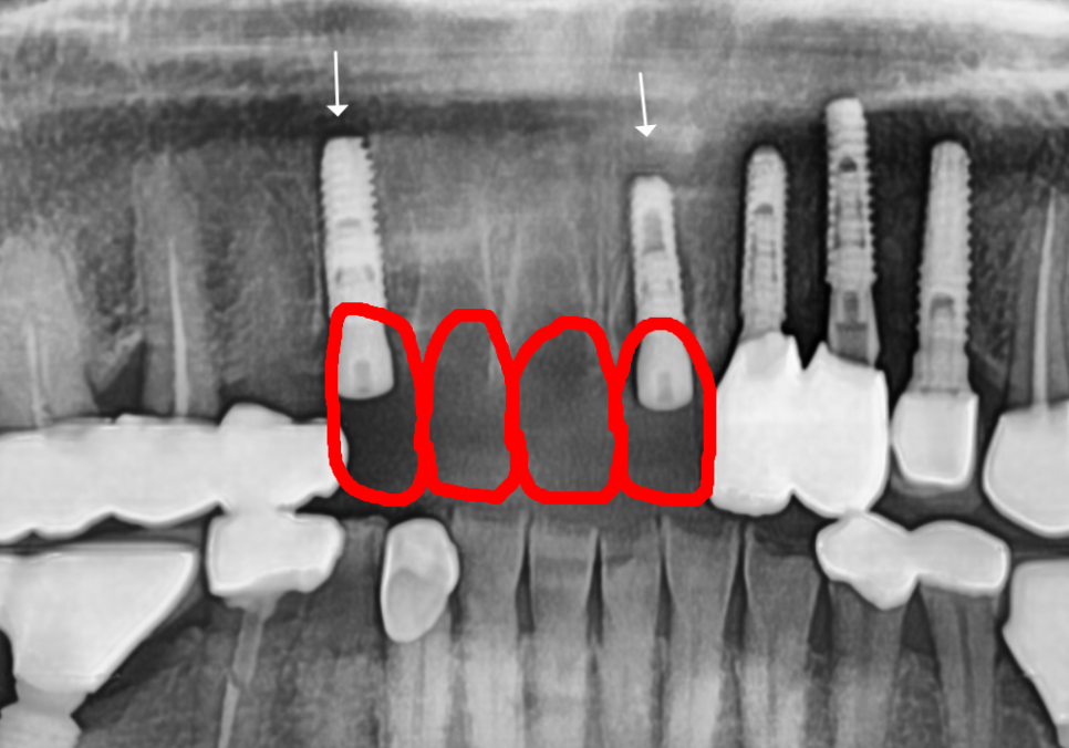 앞니 브릿지 탈락, 씌워둔 게 빠졌어요. 다시 붙일 수 있을까요? 관련 이미지 13