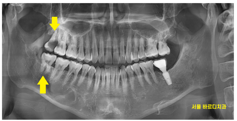 미사 사랑니 뽑아야하나 말아야하나 딱! 정리해드릴께요 관련 이미지 5