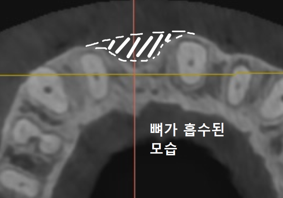 앞니 잇몸 꺼짐, 잇몸 이식 없이도 임플란트 할 수 있는 방법 공개합니다. 관련 이미지 7