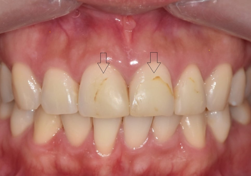 고덕역 치과 반점치 얼룩덜룩한 치아, 치료 실패 줄이는 5가지 기준 관련 이미지 4