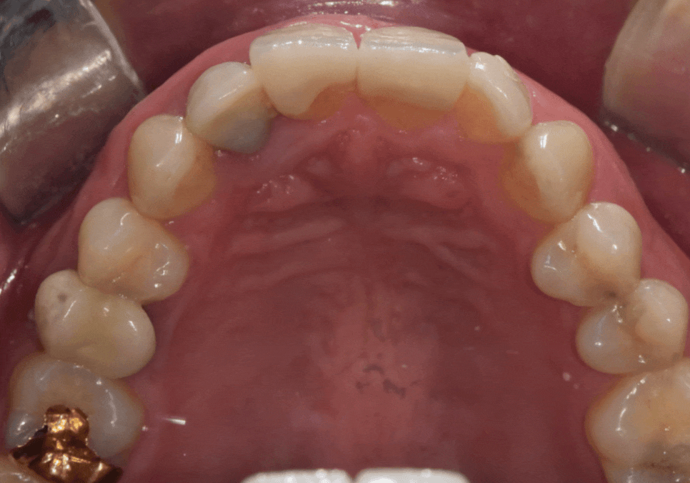 앞니 덧니, 교정은 싫고 시간은 없다면? 라미네이트로 해결한 사례 관련 이미지 13