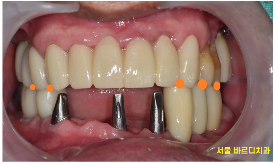 외국인 치과 진료 하악 전체 임플란트 7개 심어 12개 치아 만들기 관련 이미지 12