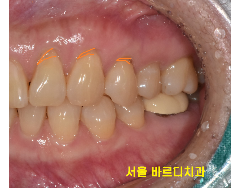 뜨거운 물 시큰 오히려 위험한 신호입니다!! 관련 이미지 1