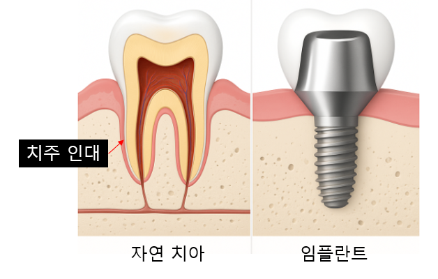 임플란트 고름 나오고 통증이 느껴질때 어떻게 해야할까요? 관련 이미지 3