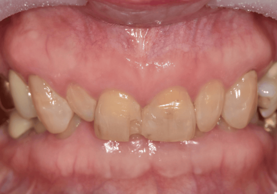 중장년 라미네이트, 70대도 가능한가요? 왜소치와 벌어진 앞니 해결 사례 관련 이미지 8