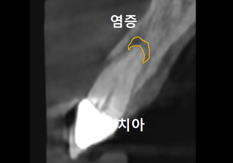 앞니 임플란트, 원내 기공소의 중요성을 아시나요? 관련 이미지 13