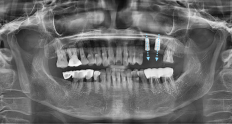 서울 네비게이션 임플란트 치과 불안할 때 좋은 선택지가 될 수 있습니다. 관련 이미지 7