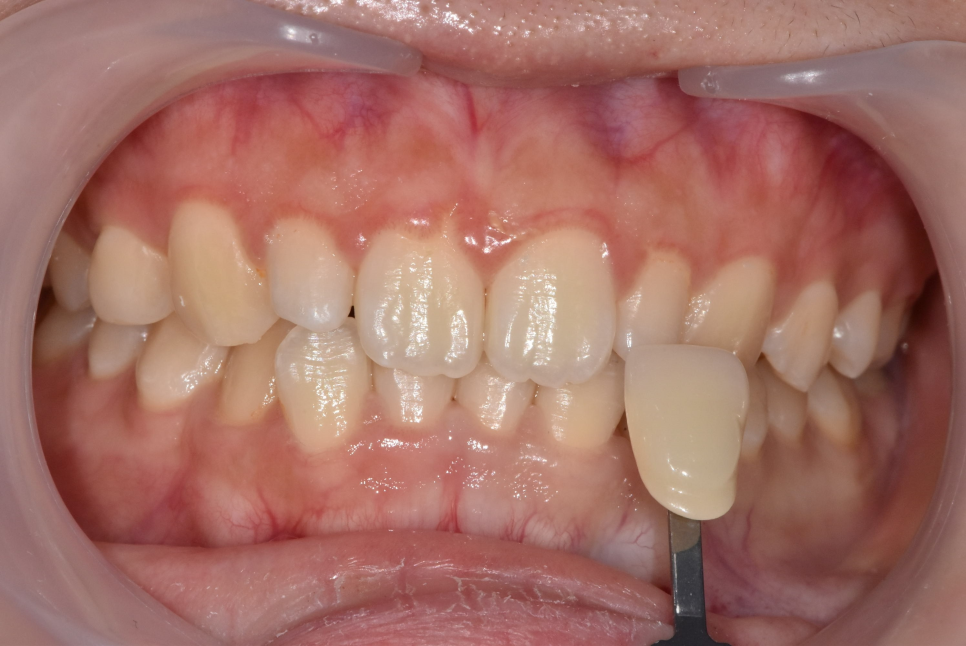 강동구 치아 미백 과정 확인하고 환한 미소로 웃어봐요 우리 관련 이미지 2