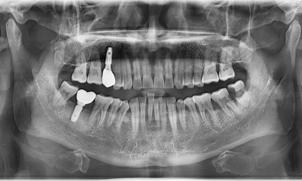 My Teeth Are Shaking So Much That Eating Is Uncomfortable—Is It Okay to Just Leave Them Alone? image 14