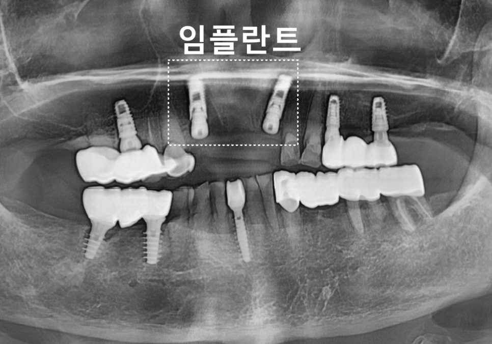 상일동 임플란트 심한 충치로 인한 치아 부러짐 해결한 사례 관련 이미지 5