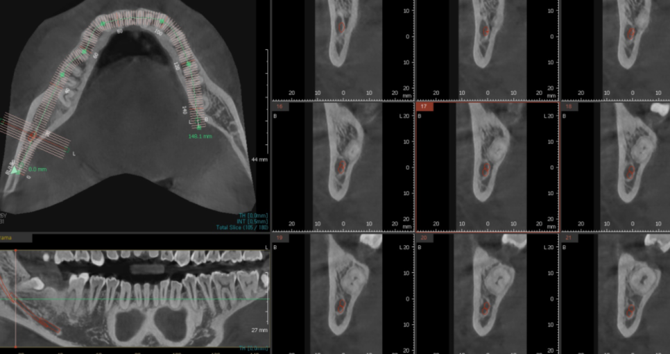 미사 사랑니 뽑아야하나 말아야하나 딱! 정리해드릴께요 관련 이미지 4