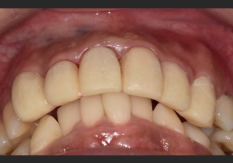 A Single Black Spot of Decay Between the Front Teeth May Be a Warning Sign of Multiple Cavities. image 11