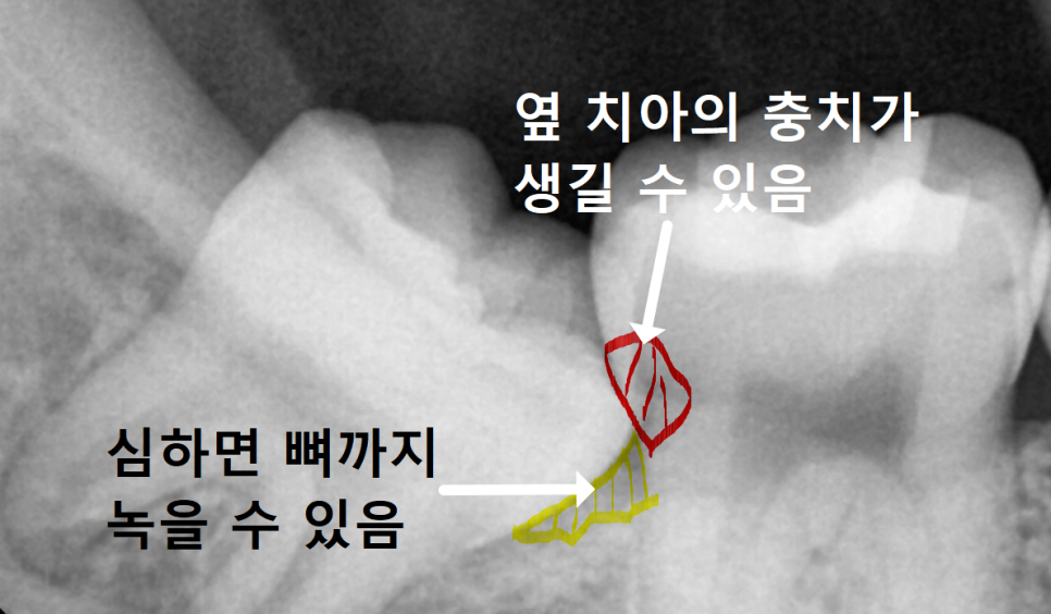 상일동 사랑니 매복 방치하다 옆 치아까지 망가진 실제 사례 관련 이미지 2